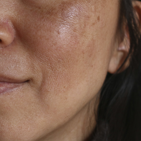 Tratamento de Melasma - Acroma-QS
