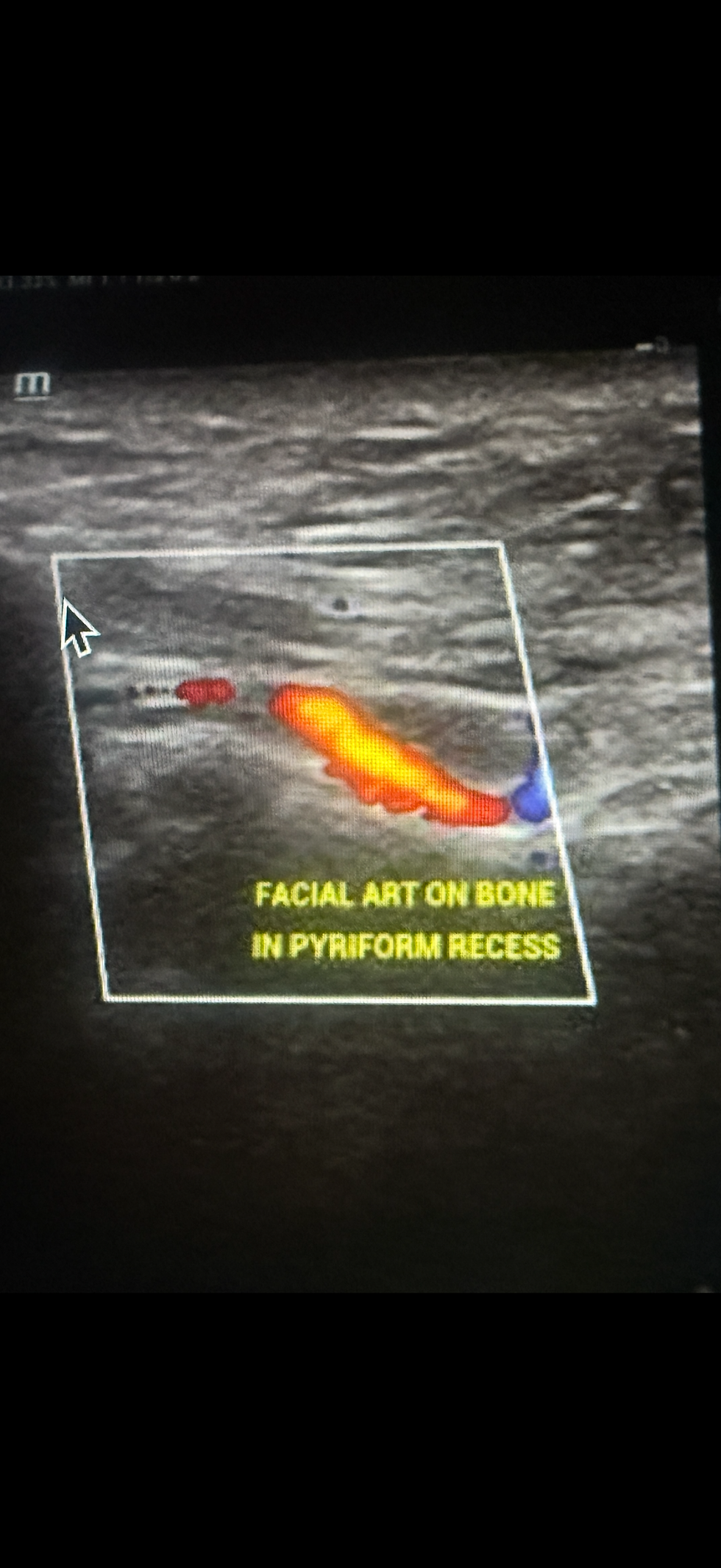 Advanced facial ultrasound education for injection safety
