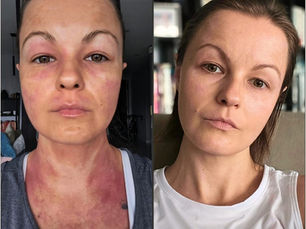 Before-and-after images of a woman highlighting skin improvement. Left shows redness; right shows clear skin. Text reads "Before" and "After".