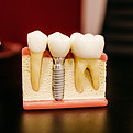 Implante dental
