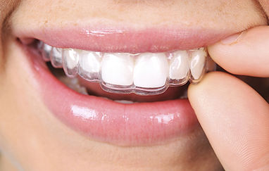 dentalwork_invisalign_jpg-600x390_jpg-60
