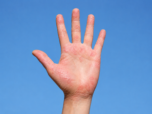 ECZEMA CHRONIQUE DES MAINS : MIEUX DIAGNOSTIQUER, MIEUX PREVENIR, MIEUX TRAITER