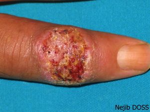 La leishmaniose cutanée : un conte de faits