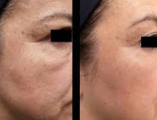 Skinbooster no Studio Carvalho