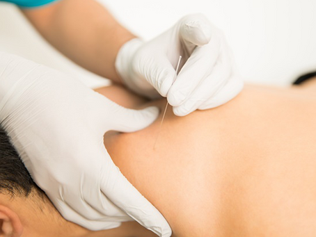 Dry Needling