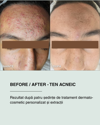 Before after tratament acnee la nivelul frunții, reducerea coșurilor și a punctelor negre, Otopeni