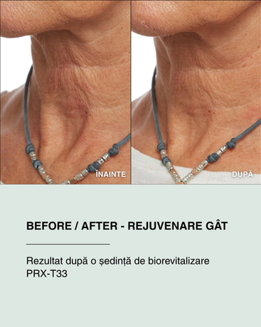 Before after rejuvenare gât PRX-T33, tratament antiaging pentru riduri gât, laxitate cutanată și textură creponată, îmbunătățirea fermității pielii