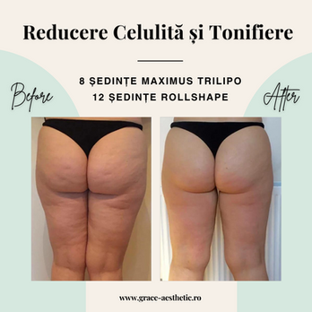 masaj celulita tonifiere grace aesthetic otopeni radiofrecventa rollshape