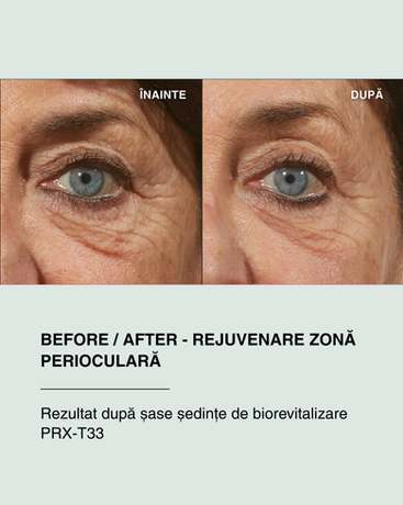 Before after rejuvenare zonă perioculară PRX-T33, tratament pentru riduri ochi, riduri laba gâștii, cearcane, textură neuniformă și fotoîmbătrânire