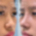 Asian Rhinoplasty recovery and cost