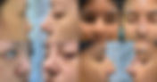 TALE OF TWO NOSE - CAUCASIAN AND ASIAN RHINOPLASTY