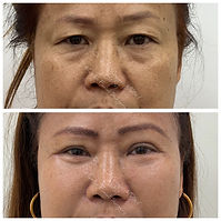 cheek lift surgery Dr Rahul Gogoi.JPG