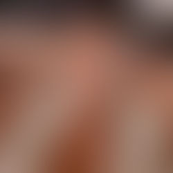 dermaplaning skin facial