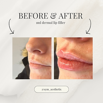 1ml dermal lip filler