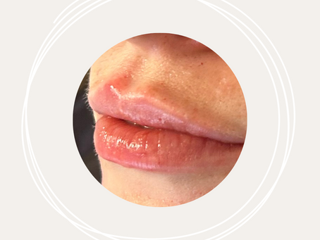 Lip Augmentation: A Guide to Achieving Natural-Looking Plumpness
