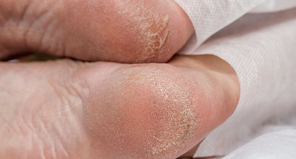 The Dangers of Ignoring Dry, Cracked Feet, Especially for Seniors