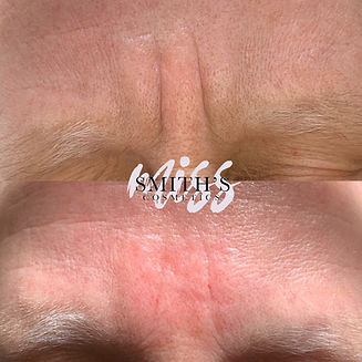Dermal Filler Frown Lines