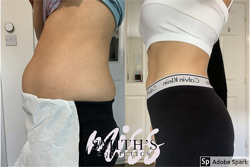 Fat Dissolving Injections YLB Shrewsbury