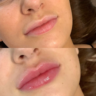 Dermal Fillers Lip Fillers