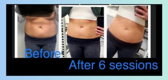 before and after weight loss body sculpting