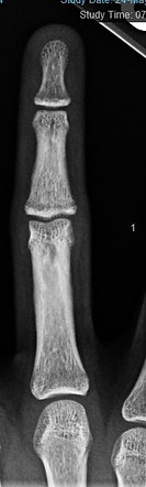 Xray of 13yo female after 6 weeks of treatment for growth plate injury - back in business! (another view)
