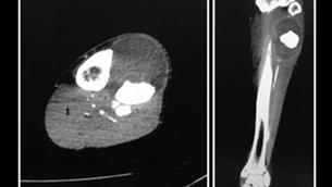 Giant Anterior Tibial Artery Pseudoaneurysm Successfully Treated on the USNS Mercy