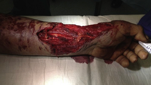 Limb Salvage After Vascular Reconstruction Followed by Tissue Transfer During the Global War on Terror