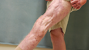Flap Coverage Outcomes following VascularInjury and Repair: Chronicling a Decade ofSevere War-Related Extremity Trauma