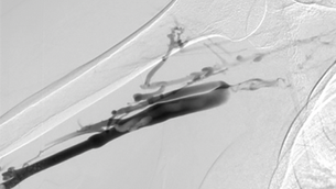 Paget-Schroetter Syndrome in Nonathletic31-Year-Old Female Without Hypercoagulopathy