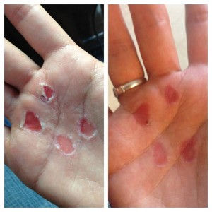 Thumbnail: Winnies RipFix™ for ripped and torn hands