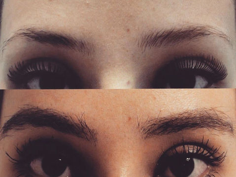 eyebrow Hair transplant in Dubai