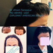 Dr Ahsen Hair Transplant Dubai