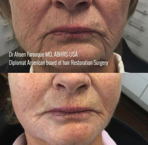 Dr Ahsen Hair Transplant Dubai