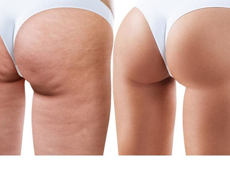 Celulitis…¿aunque te cuides sigue ahí? Como combatirla de forma real según tú tipo y tiempo