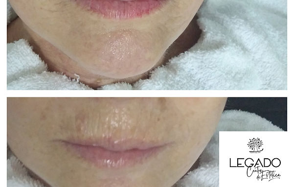 Tratamiento rellenar lineas expresión labio Legado estética Manacor