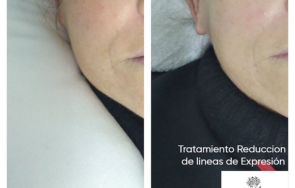 tratamiento reduccion arrugas Legado estética Manacor