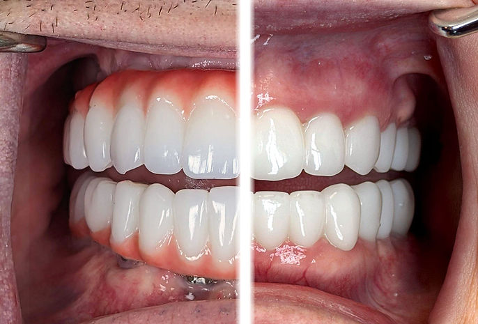 Split screen comparison of All-on-4 vs 3 on 6 showing retracted gums and teeth