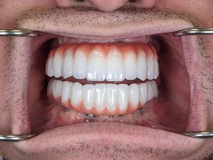 What You Should Know About All-On-4 Dental Implants