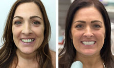How 3 on 6â„¢ Dental Treatment Transformed Melissa's Smile and Confidence