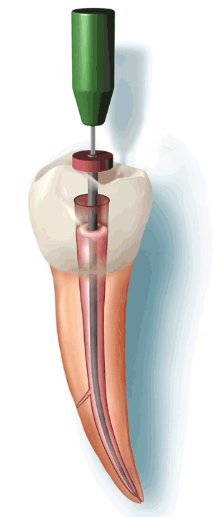 root-canal.gif