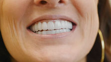 Patient with an FP1 restored smile