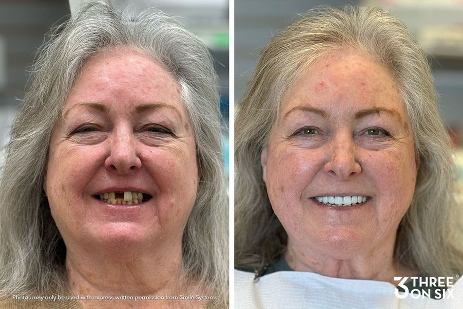 Before and after of 3 on 6 patient