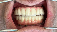 Close up of All-on-4 in patient's mouth