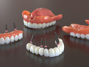 Prosthetics for dental implant treatment