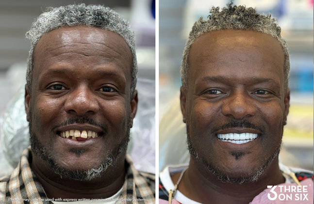 Before and after of 3 on 6 patient
