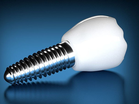 Dental Implants