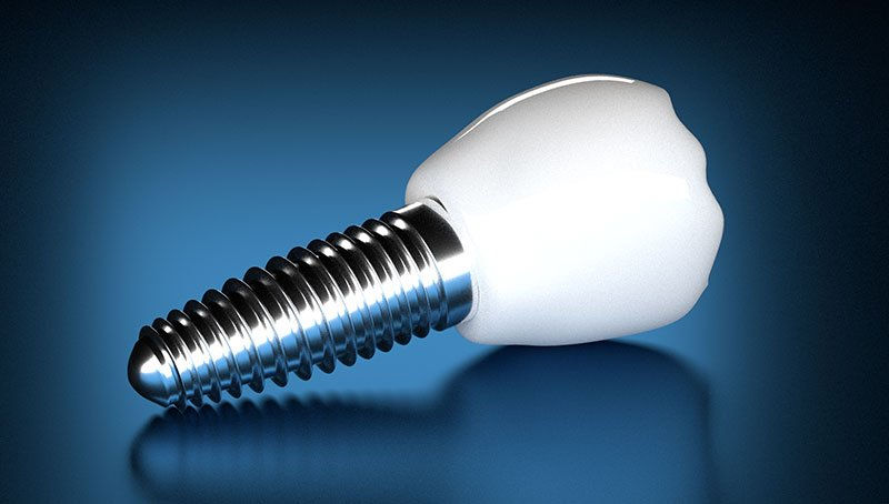 Why Are Dental Implants So Expensive 
