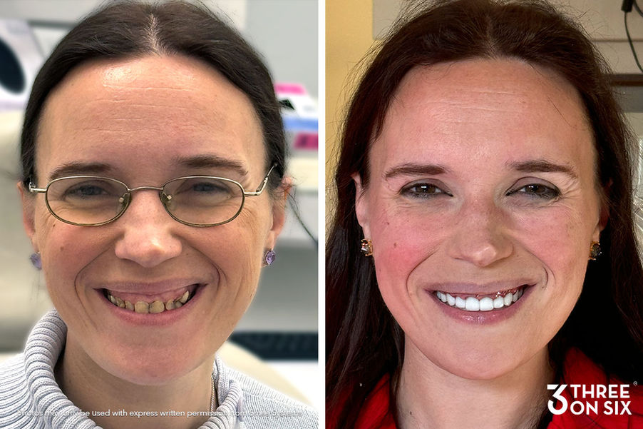 Before and after of 3 on 6 patient