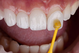 cosmetic_veneers1.jpg