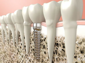 The Science Behind Bone Preservation and Dental Implants